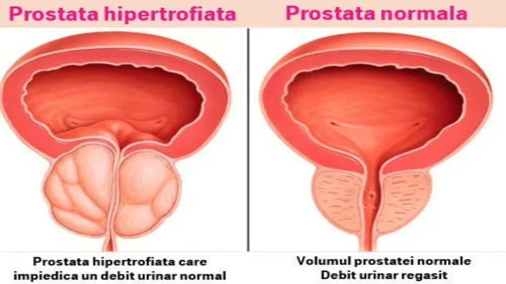 Erexol cum sa o ia - cum functioneaza - ce este - compoziție - ingrediente - dozare